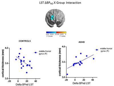 Differential Associations between Cortical Thickness and Striatal Dopamine in Treatment-Naïve Adults with ADHD vs. Healthy Controls